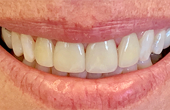 Perfected healthy smile after dental treatment